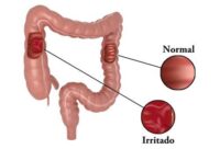 Enfermedades más comunes del intestino grueso