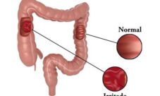 Enfermedades comunes del intestino grueso