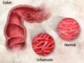 ¿Qué es el intestino grueso inflamado?